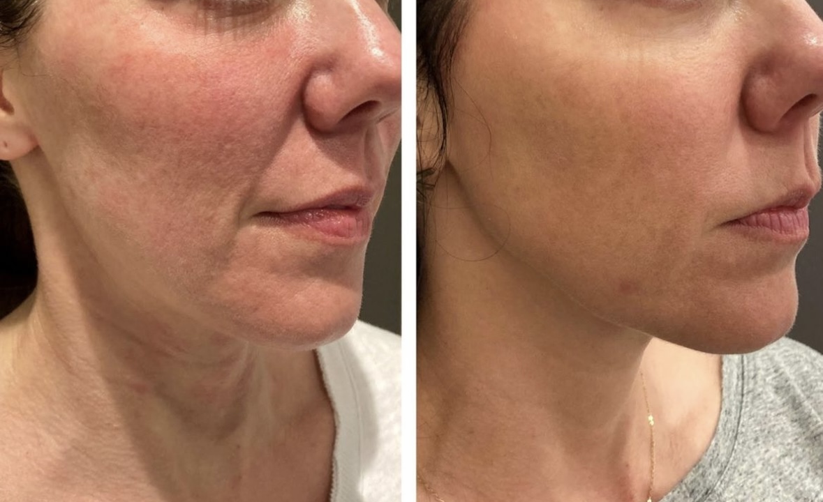 Face & Neck Contouring Greenville Clemson Eye Aesthetics