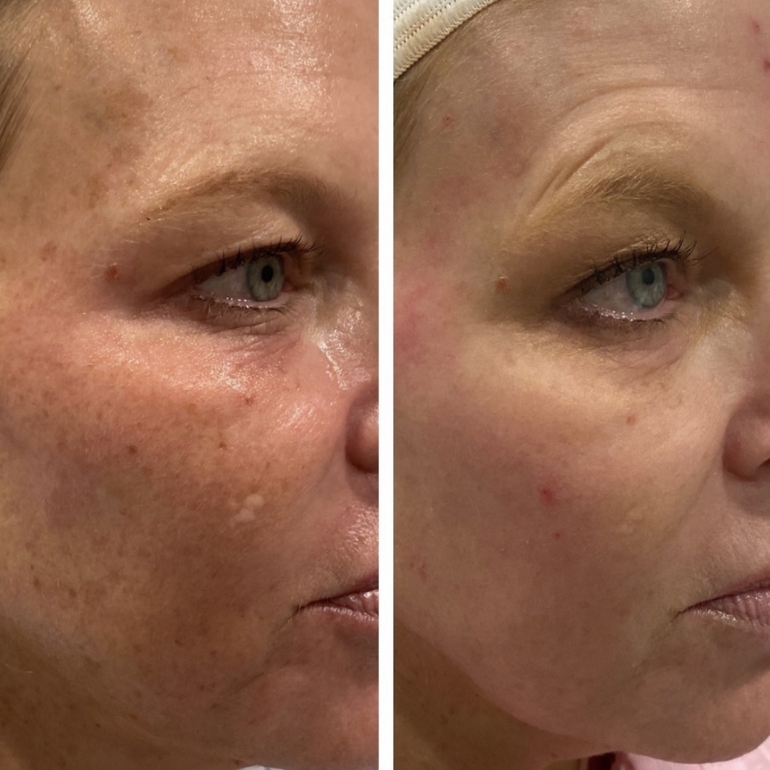 Laser Treatments Before and After