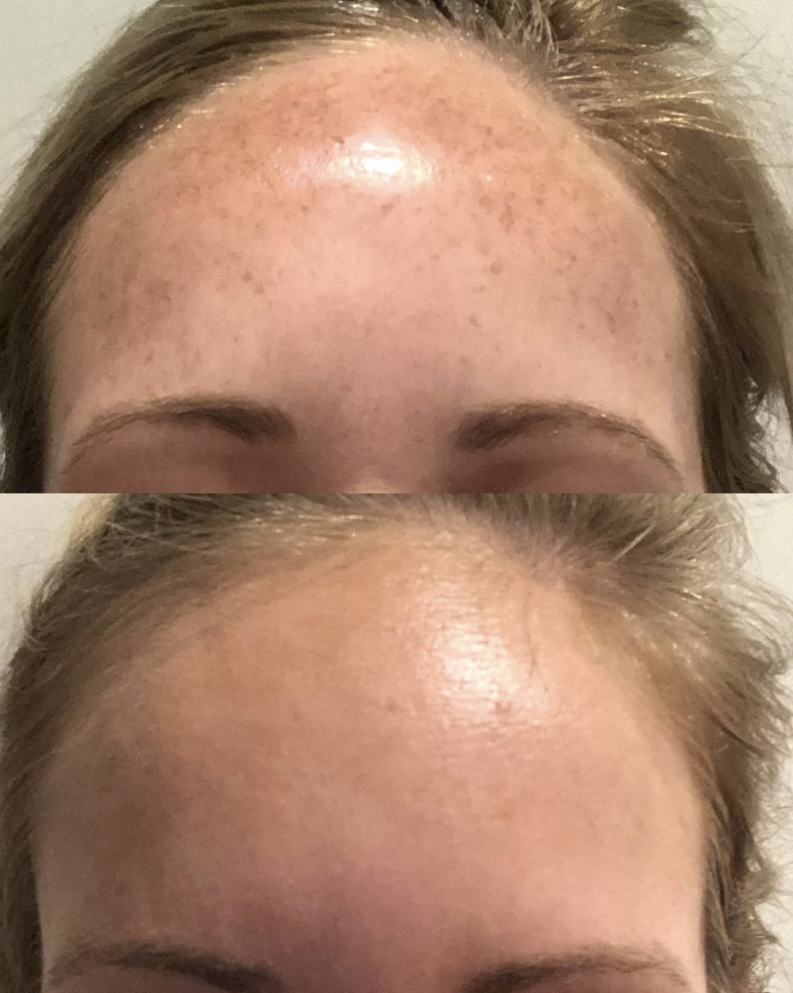 Laser Treatments Before and After
