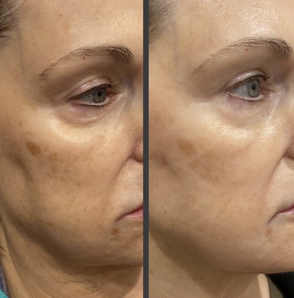 Laser Treatments Before and After