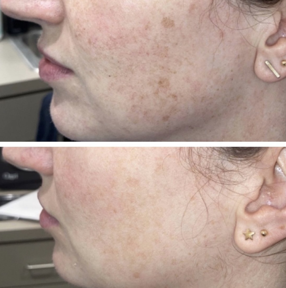 Laser Treatments Before and After