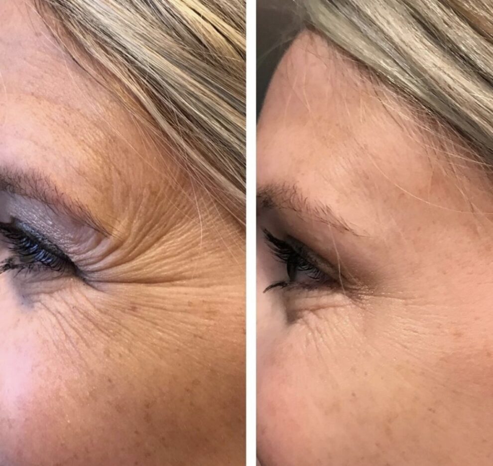 Botox/Dysport Crow Lines Before and After