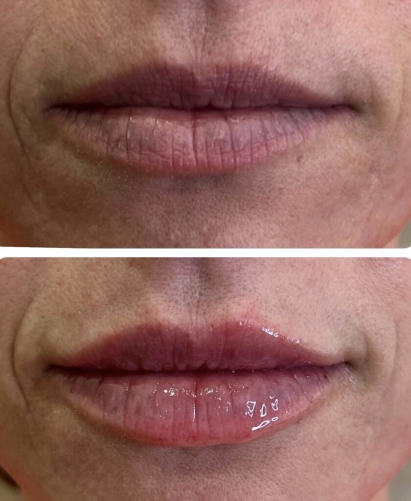 Injectables Lips Before and After