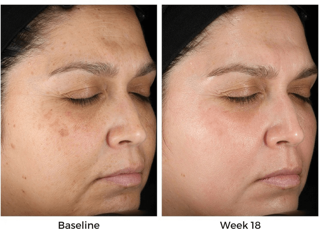 Obagi Nu Derm Before and after