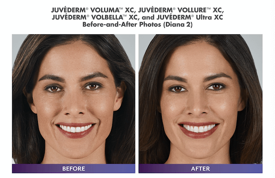 Juvederm Before and after