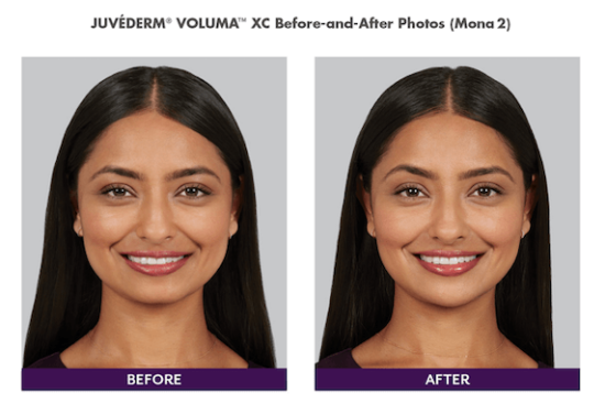 BOTOX Greenville | Injectables Seneca | Clemson Eye