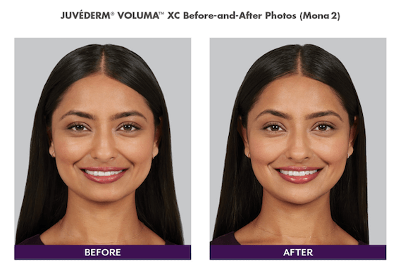 Juvederm Before and after