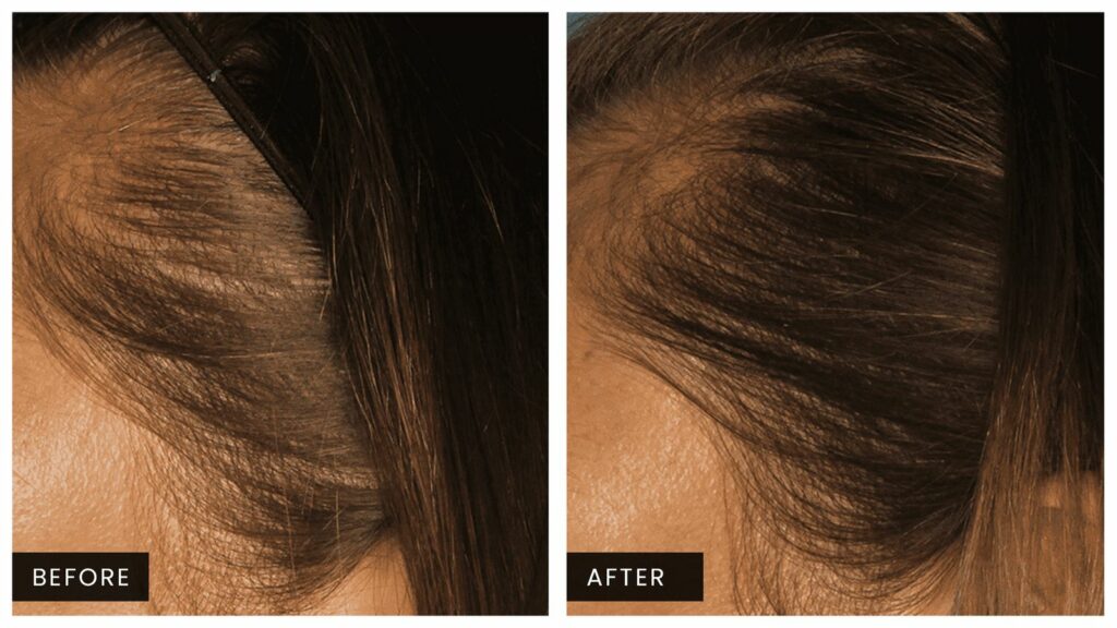 Injectables Before and After