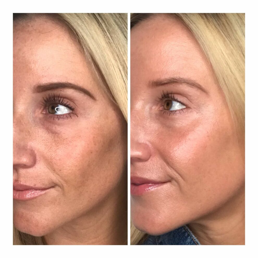 halo before and after laser treatment