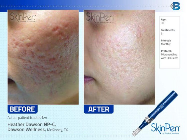 skinpen before and after