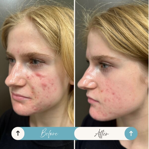 Swipe to see these amazing Before and Afters with Whitney Pope, LE using the Sciton Broad Band Light Laser! 😍It's time to have confidence in your skin!

This patient had a customized treatment plan starting with 1-2x per week, then bi-weekly, and monthly. She is now in maintenance mode with 4 months in between her last two visits! In addition to the BBL was Medical-Grade Skincare, consistency, & patience! 🤍

Call 864.622.5005 to schedule your BBL with Whitney Pope in Simpsonville! ✨

BroadBandLight BBL WhitneyPopeLE AcneTreatment Sciton MedicalGradeSkinCare LaserTreatment ClemsonEyeAesthetics CEA Simpsonville